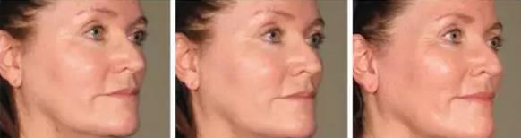 超声刀战胜法令纹原理,超声波祛法令纹有用吗