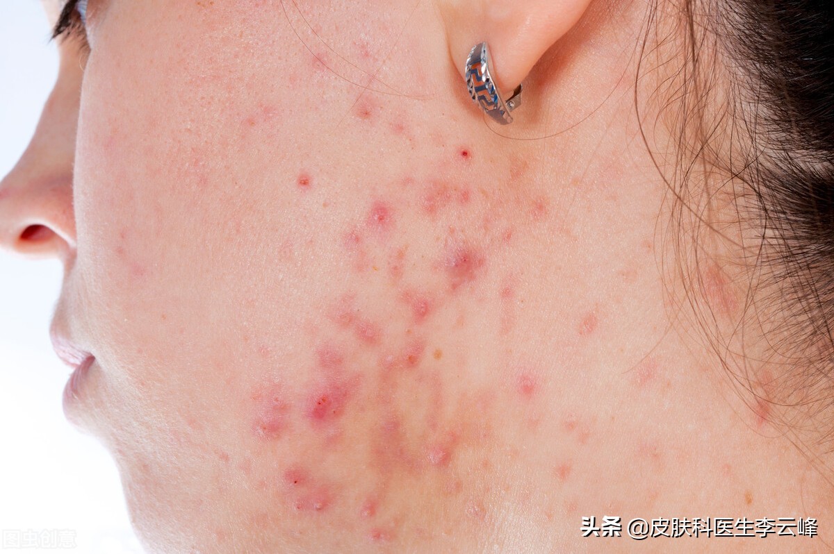 经期长痘是什么原因,经期长痘是什么原因引起的