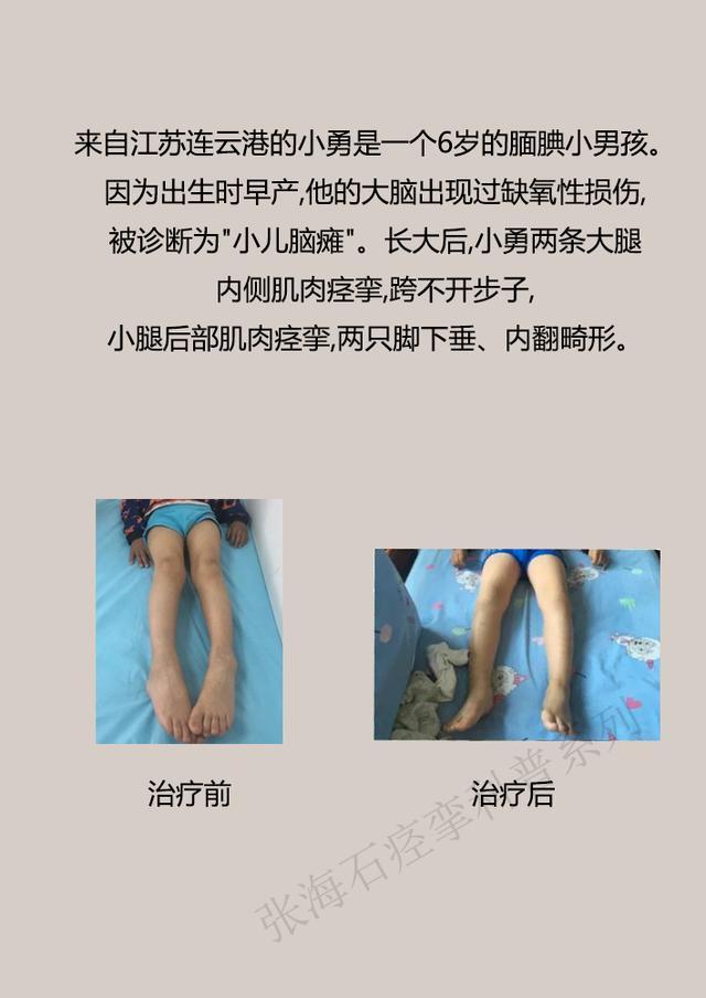 眼睑痉挛如何治疗,痉挛状态如何缓解