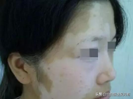 白癜风一边好一边发展怎么回事,白癜风在治疗中为啥还会发展