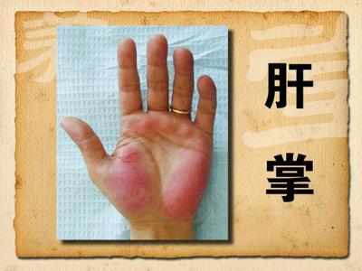 手部出现3种异样可能患癌,手出现问题是什么病前兆