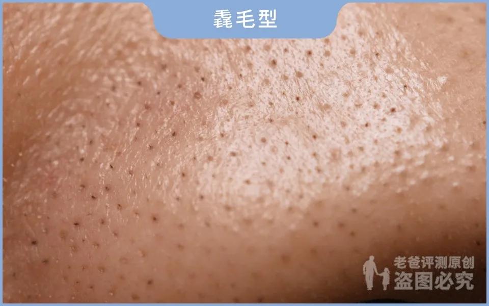 黑头怎么从根部去除,黑头到底怎么去