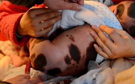 先天性巨痣怎么申请公益救助,先天性巨痣和胎记的区别