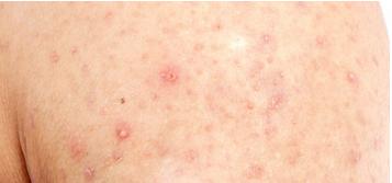 增强ct造影剂过敏还能做放疗吗,放疗为啥做强化ct定位