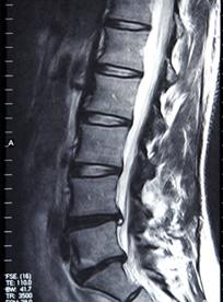 腰椎间盘突出疼痛的最好方法,腰椎间盘突出吃什么营养神经药物