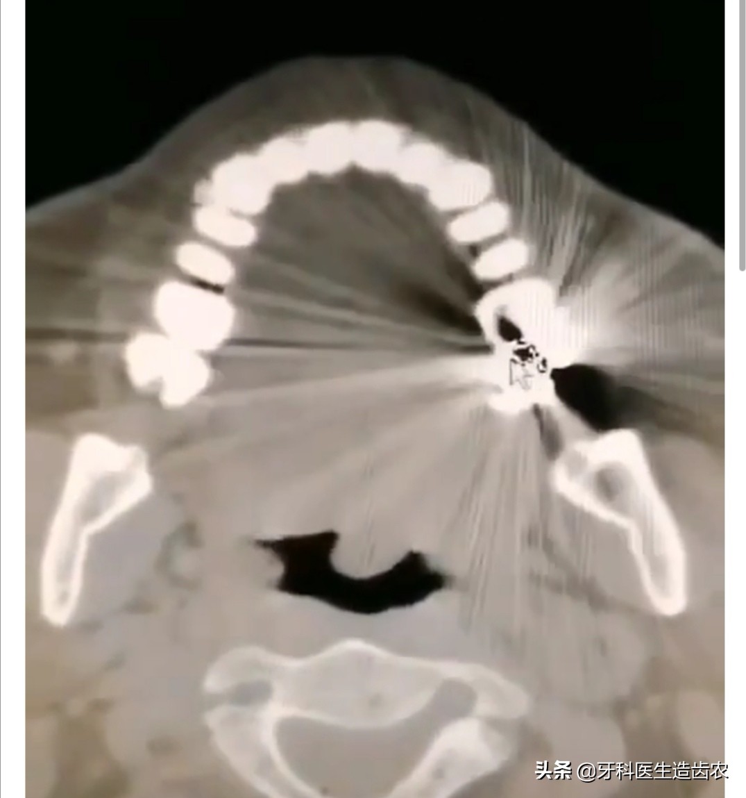 武汉烤瓷牙哪个医生做得最好,想做烤瓷牙该如何选择