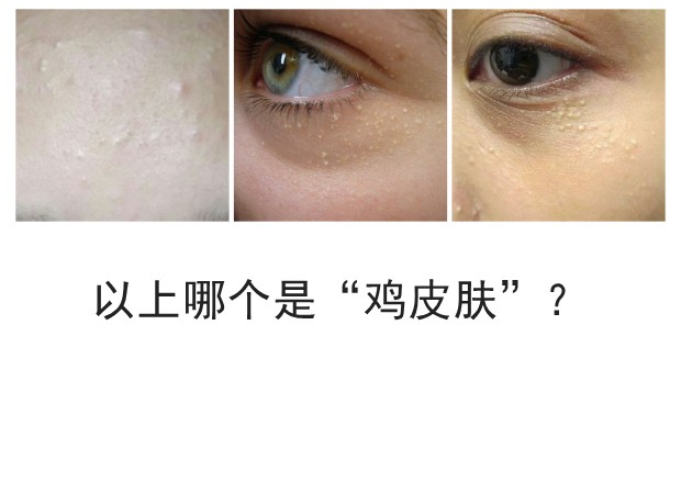 长汗毛导致的鸡皮肤怎么办,女生有鸡皮肤的解决方法