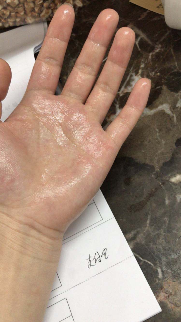 解决“水手”难题,水矿总医院成功治愈首例“手汗症”