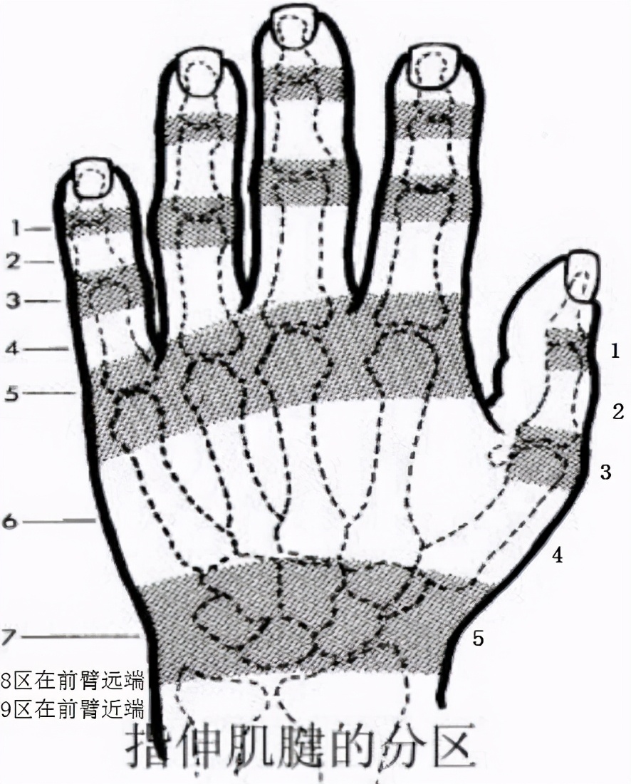 拇指伸肌腱手术后怎么做康复,伸肌腱止点重建术后的康复