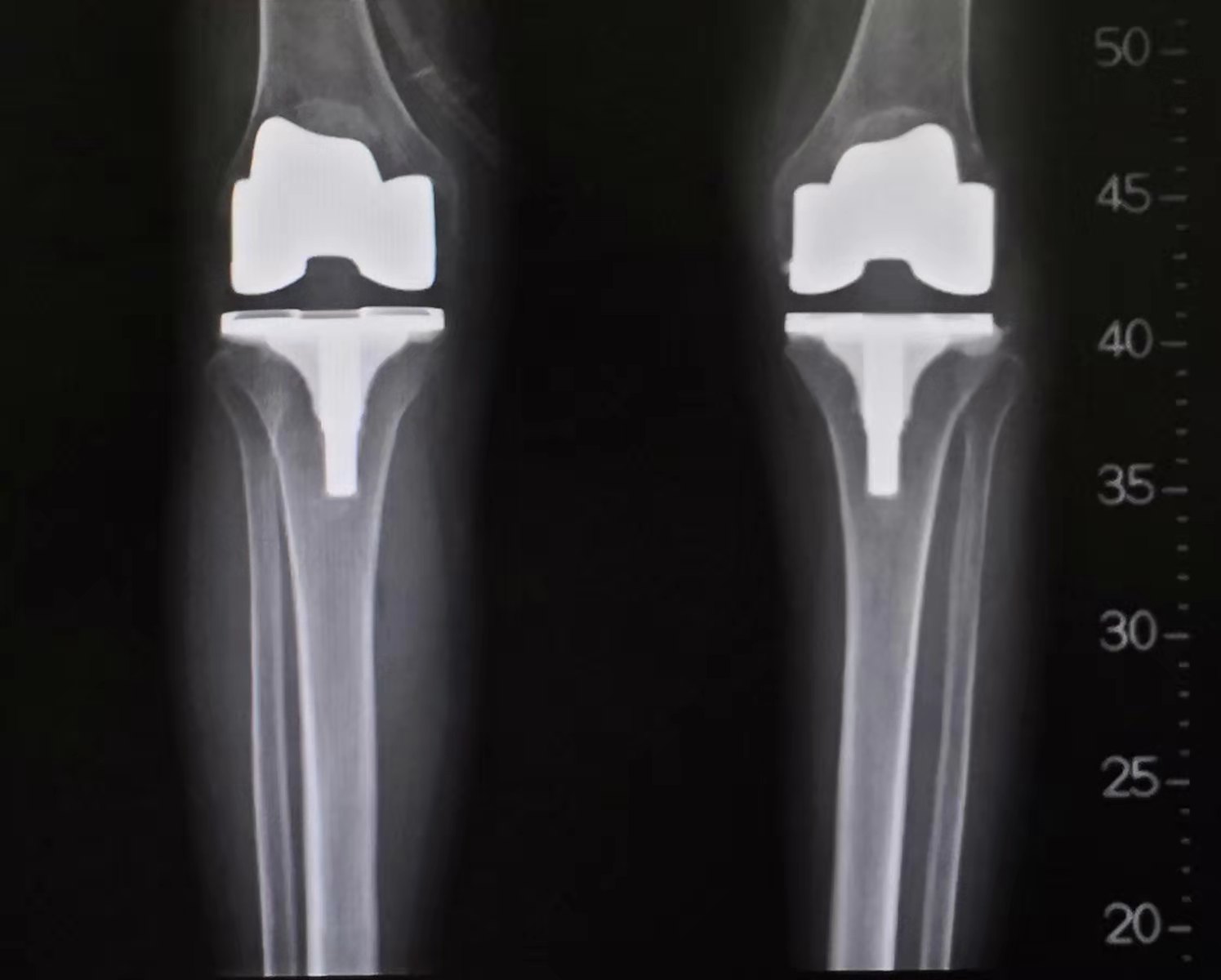 双膝功能障碍患者通过TKA手术重获行走功能