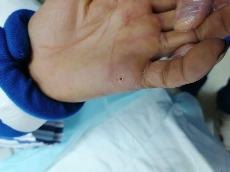 有铁锈的刀划伤一定会破伤风吗,被生锈铁器划伤得破伤风几率高吗