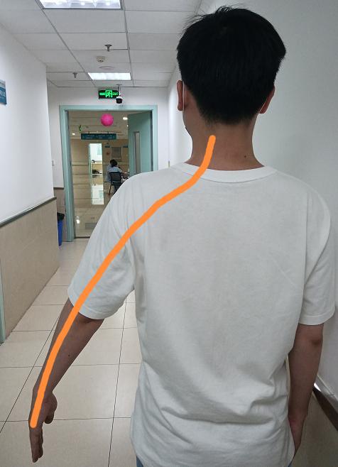 每天三个动作轻松治愈肩周炎,医生教你们肩周炎的最佳锻炼方法