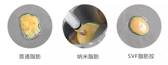 注射除皱玻尿酸和除皱针要怎么选,注射除皱和填充