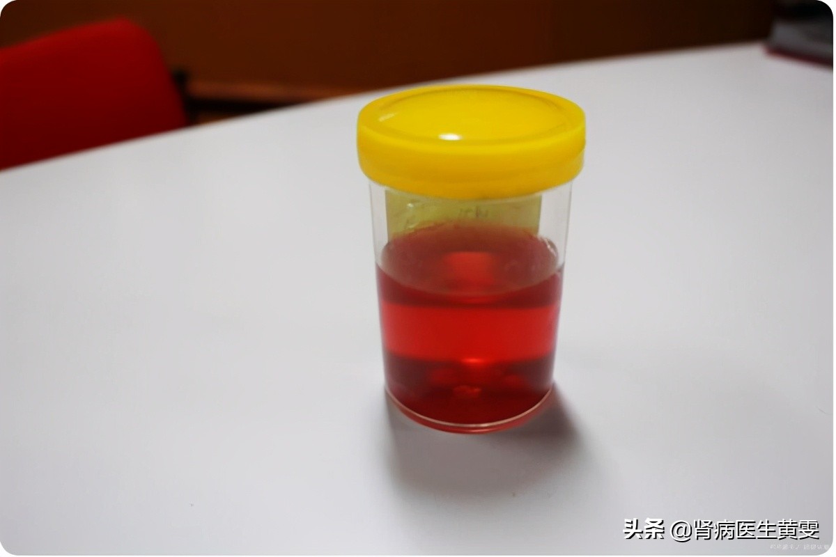 小伙吃夜宵喝啤酒肾衰,喝酒导致的肾衰竭案例