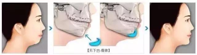 隆下巴后,整张脸都会变美了
