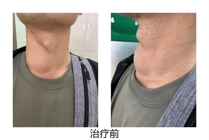 甲状腺消融术治疗甲状腺结节,甲状腺结节微创消融术器材