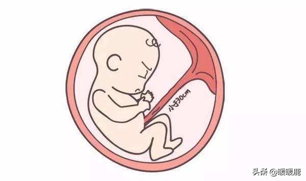 脐带绕颈几周会畸形,脐带扭转和脐带绕颈的区别