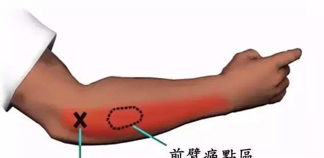 钓鱼人难免有磕磕碰碰,钓鱼保护肘关节