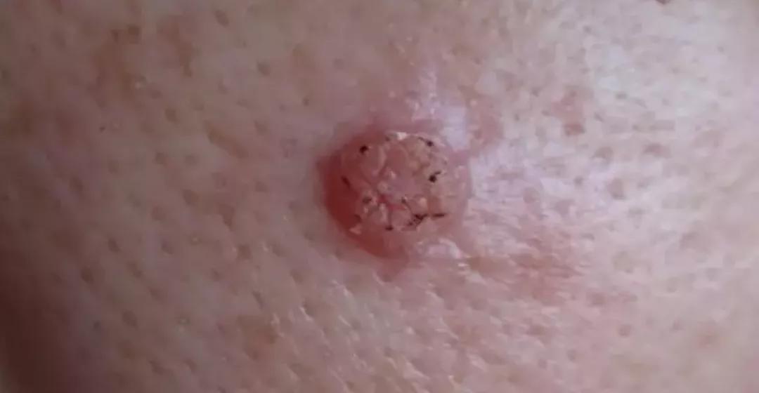 脸上长了像黑痣一样的东西,脸上长了像痘痘的东西是啥