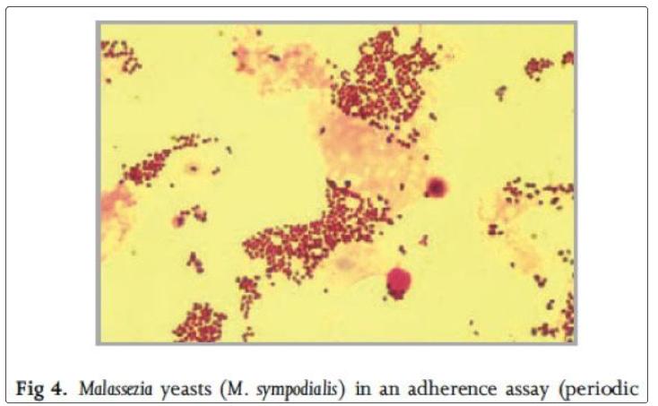 头屑多头发又掉是缺什么,头皮掉大块头屑是要秃头了吗