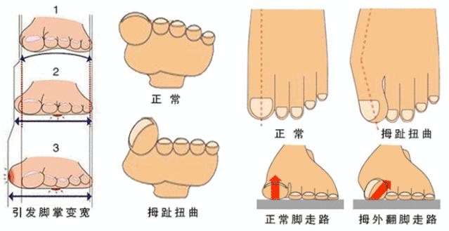 扁平足穿什么鞋都痛吗,扁平足穿什么鞋可以矫正