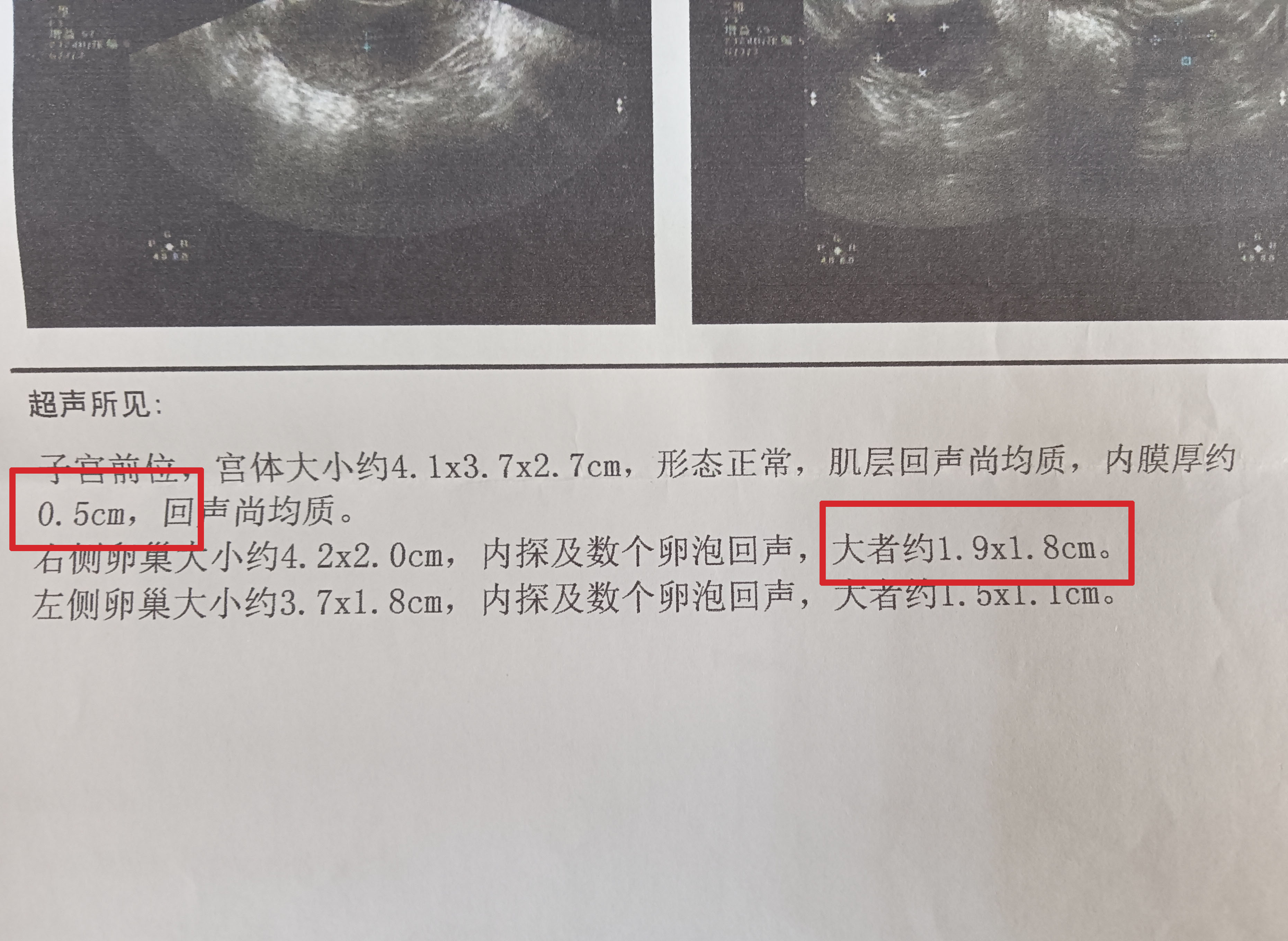 人流后内膜薄吃什么食物,人流引起的子宫内膜薄吃什么中药