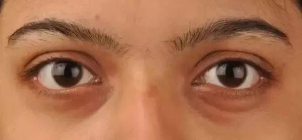 我的黑眼圈完全是熬夜熬出来的,黑眼圈是因为熬夜太多导致的吗