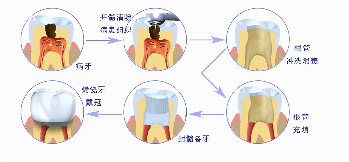 做了烤瓷牙后悔了有补救办法吗,镶了烤瓷牙应该注意事项