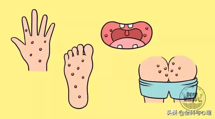 「浙一全科·转岗专区」“舌头痛”也可以是手足口病吗？