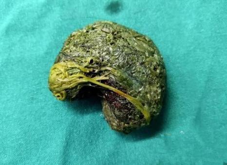 13岁女儿总说“肚子疼”，母亲骂她多事，2天后被送进医院抢救