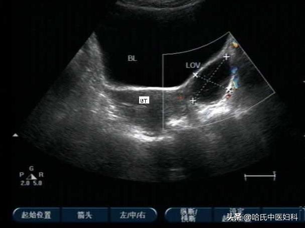 女性患有多囊卵巢不孕不育怎么办,女性卵巢性不孕怎么办