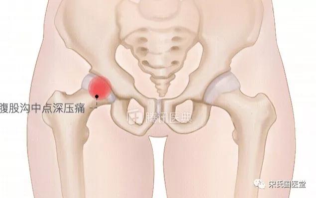 股骨头坏死漏诊图片,太康陈医生治疗股骨头坏死