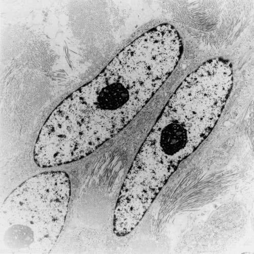 得梭形细胞瘤的人多吗,听说过肾上腺皮质瘤吗