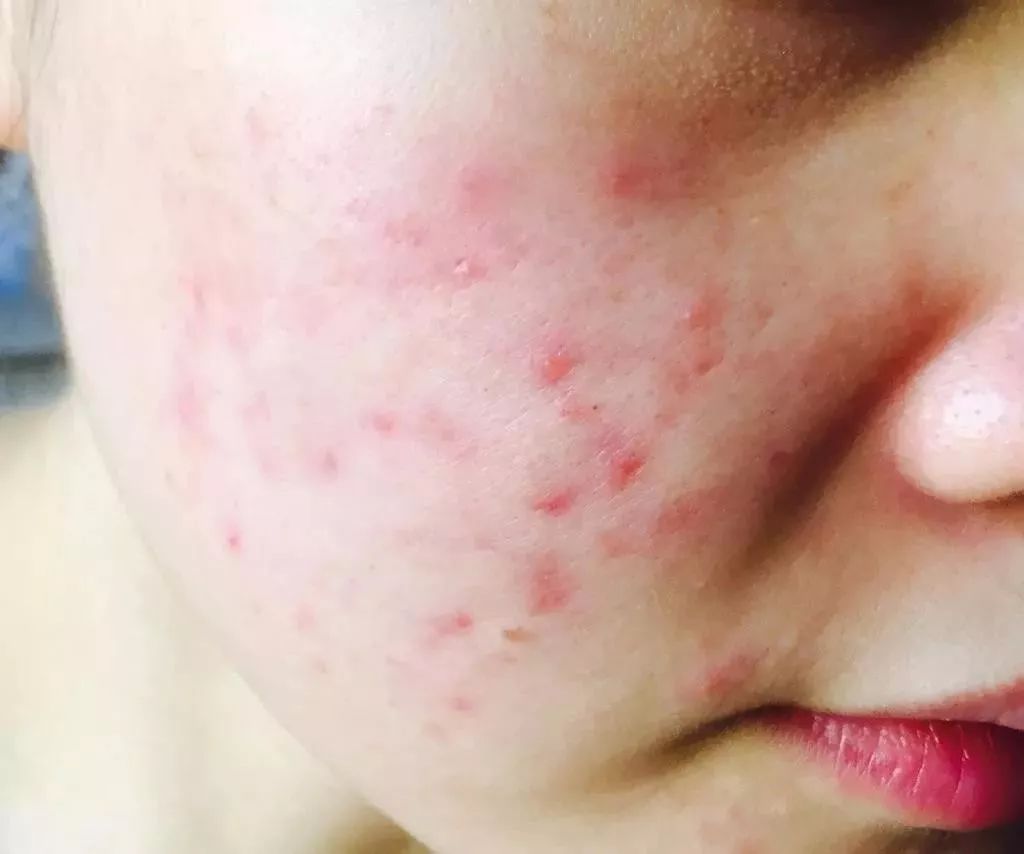 棰濆ご绮夊埡闂彛鎬庝箞鍘婚櫎,鍘婚櫎闂彛绮夊埡鐨勬姢鑲ゅ搧