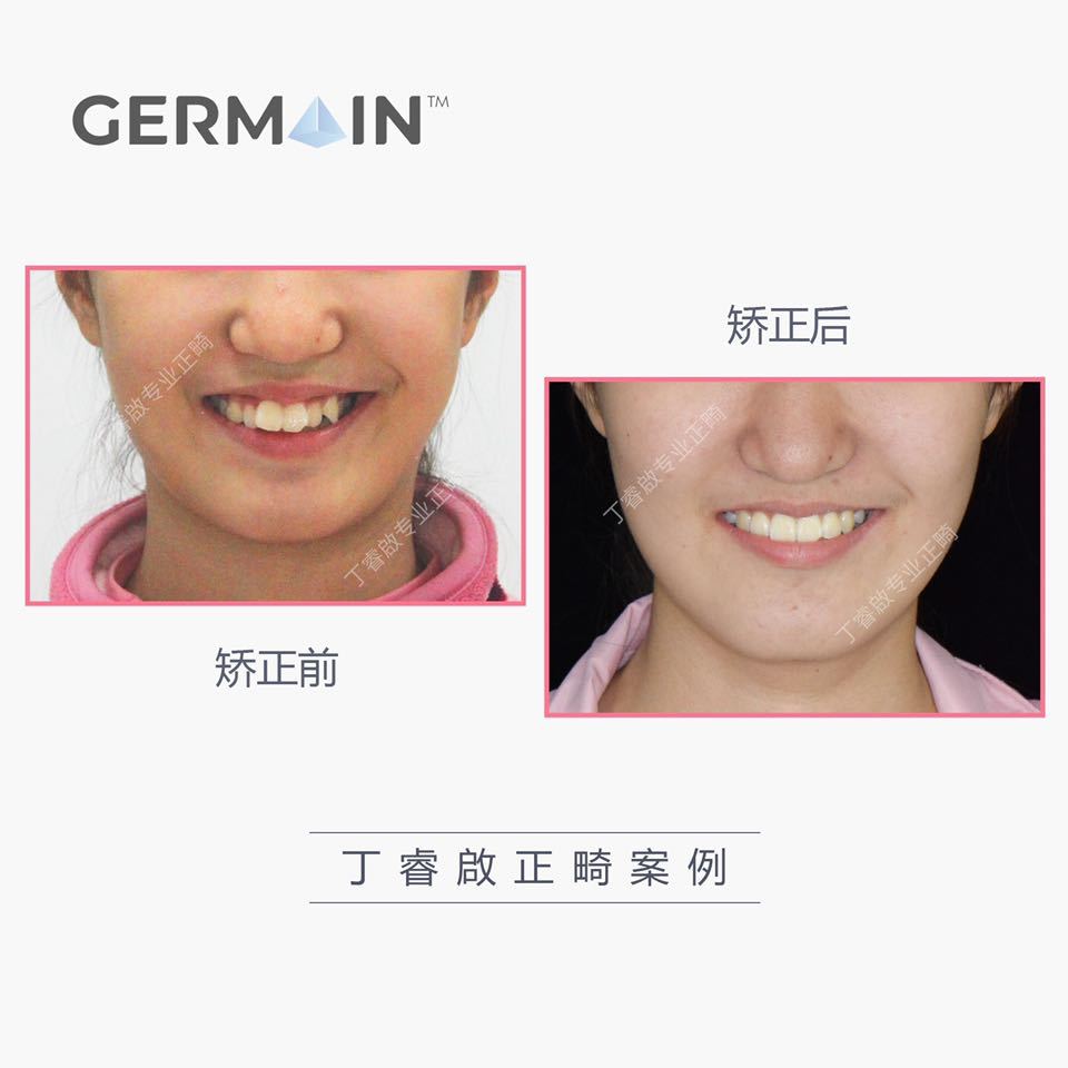 郑州牙齿矫正丁睿啟｜下巴后缩病例合集