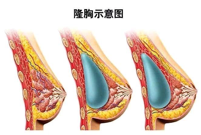 澄清隆胸传闻,辟谣隆胸真的假的