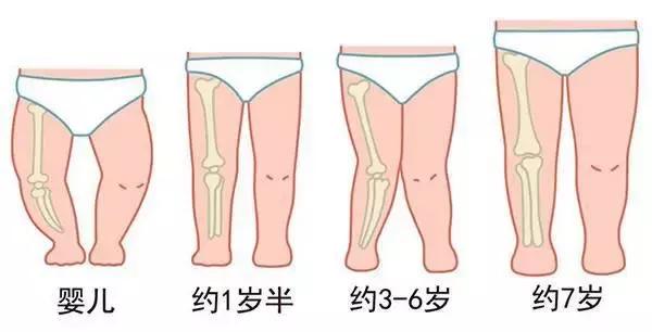 宝宝腿不矫正怎么办,宝宝腿不伸展怎么办