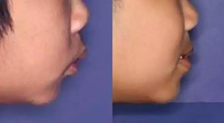 动画模拟牙齿矫正前后会变美,做了矫正牙齿会反弹吗