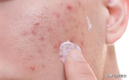 真正好用的祛痘印药膏,好用的祛痘印药膏排行榜