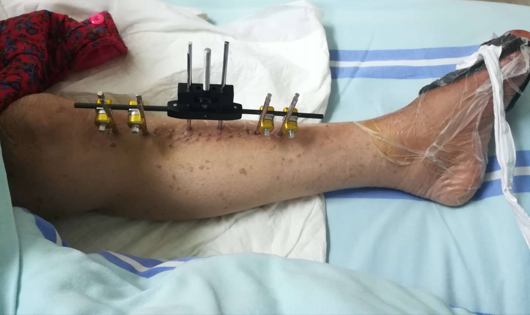 负压封闭引流治疗糖尿病足的原理,糖尿病足血管闭塞怎样治疗好