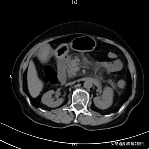 暴饮暴食导致胃脘胀满疼痛,暴饮暴食引起的腹部疼痛怎么缓解