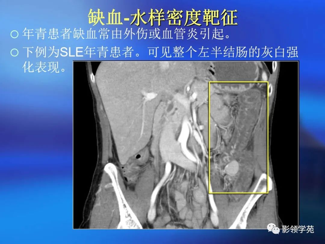 肠道内壁增厚,肠道扩张ct表现