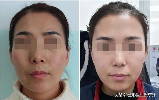 什么脸不适合做脂肪全脸填充,全脸脂肪填充的哪些部位自然