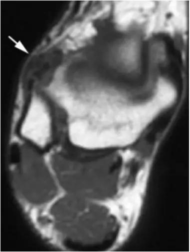 踝关节撞击症问诊,踝关节内侧撞击综合症位置图