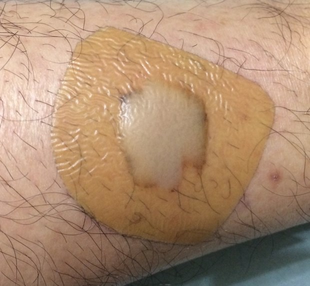 伤口感染细菌培养怎么操作,伤口被细菌感染了涂什么药