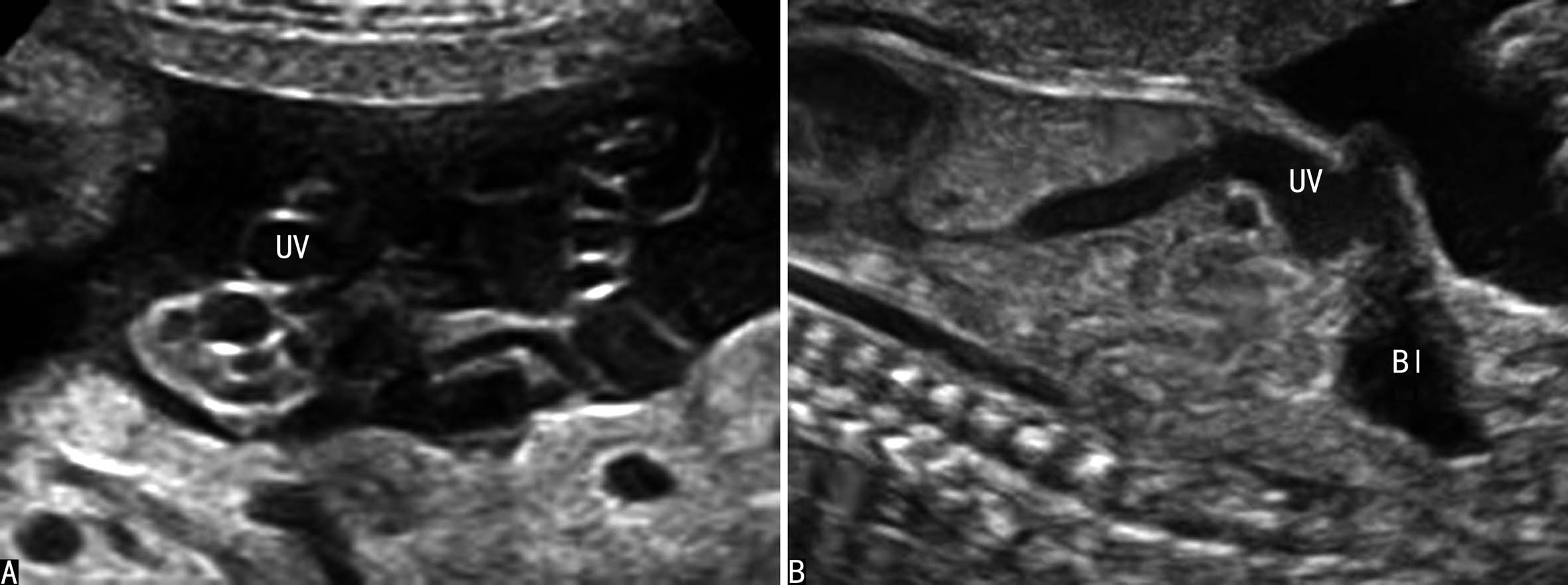 做彩超可以看出来脐带多长吗,超声检查脐带绕颈一圈正常吗