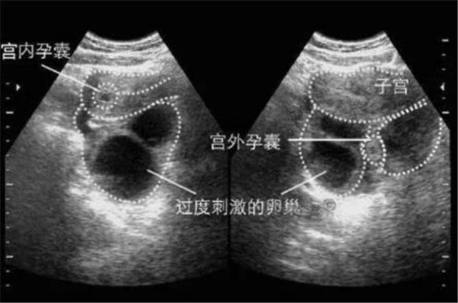 宫外孕都会给女性带来哪些伤害,宫外孕女人越来越多是什么原因