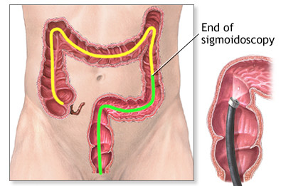 肠套叠最明显的症状有几点，多发于这些婴幼儿，黄金治疗期12小时
