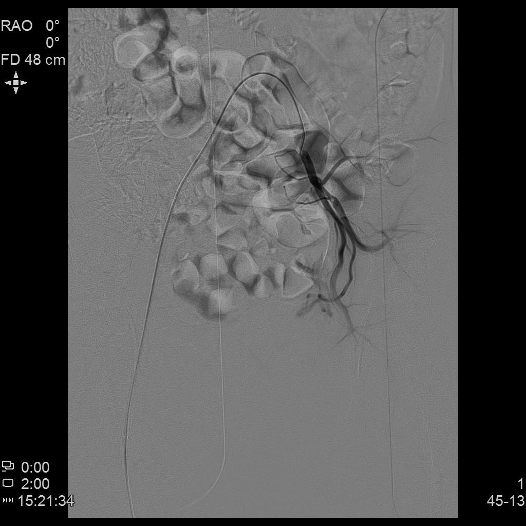 子宫腺肌症「不死的癌症」——介入栓塞来帮忙