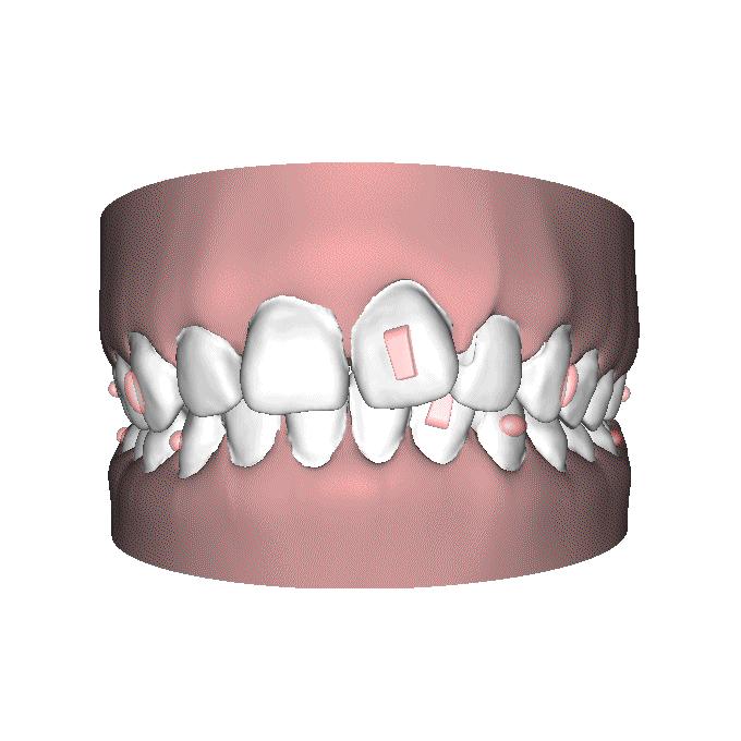 自锁托槽和隐形矫治器哪个效果好,无托槽隐形矫治器效果好吗
